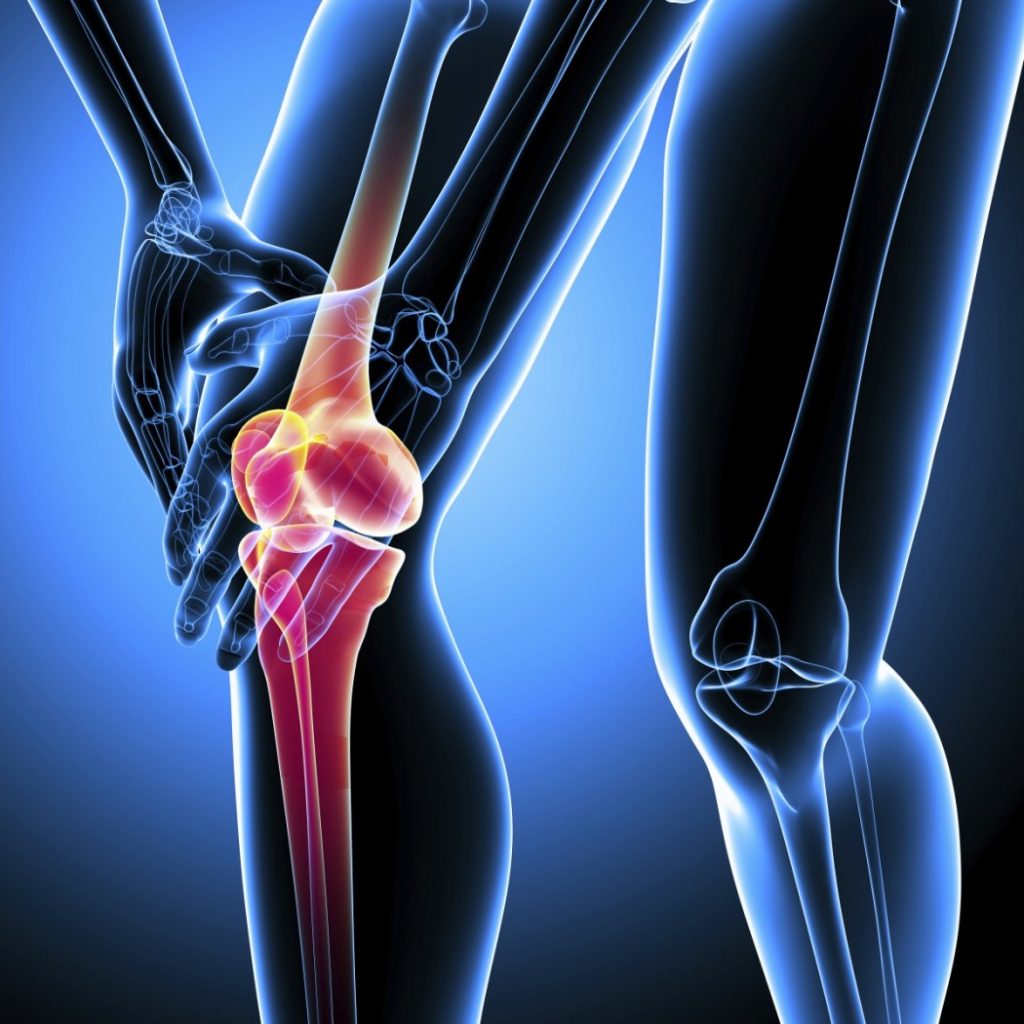 Knee Osteoarthritis 