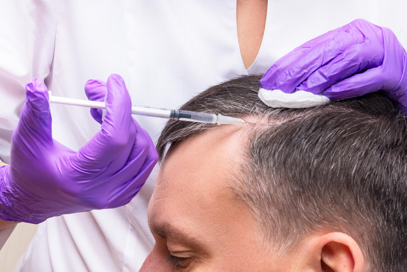 How Long Does It Take For PRP To Stop Hair Loss?